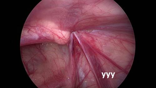 疝气手术视频,从术前准备到术后恢复