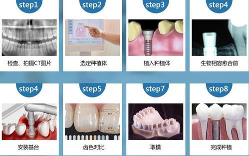 种植牙过程视频,从术前准备到术后护理