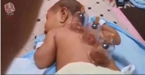 怎样拔罐视频,跟随视频学习全过程